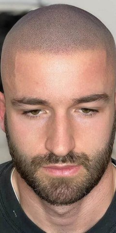 Après — densité retrouvée par micropigmentation capillaire